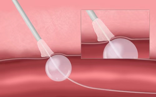 For patients undergoing diagnostic or endovascular interventional procedures via femoral artery puncture, it delivers extracascular hemostatic occlusion devices using a balloon catheter combined with a standard surgical sheath to achieve hemostasis at the femoral artery puncture site.