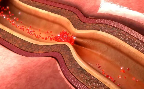 Indicated for interventional treatment of patients with symptomatic intracranial atherosclerotic stenosis in the non-acute phase, improving blood perfusion of intracranial arterial vessels by means of balloon dilation.